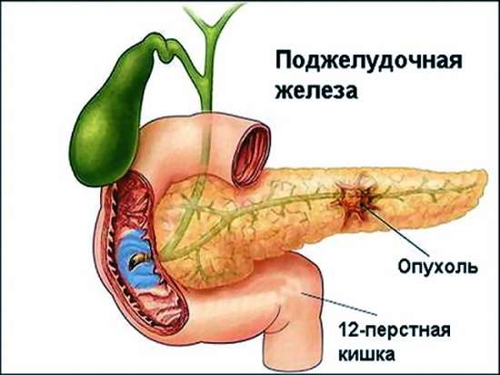 Рак підшлункової залози: симптоми і лікування Рак підшлункової залози: симптоми і лікування