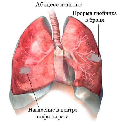 Абсцес легені: симптоми і лікування