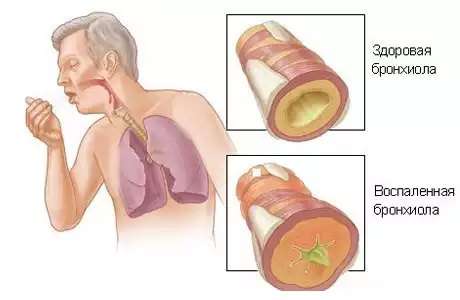 Алергічний бронхіт: симптоми і лікування