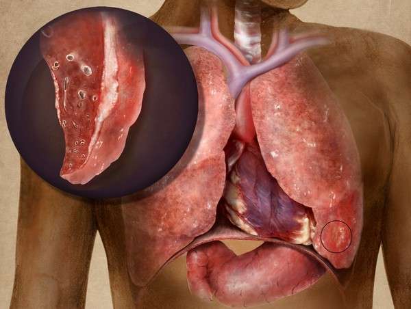 Туберкульозний плеврит: симптоми і лікування