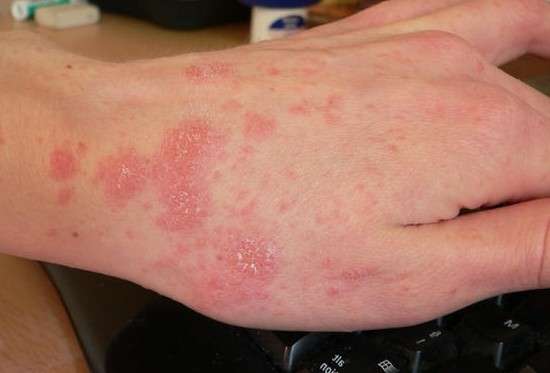 Алергія на сонце: симптоми і лікування