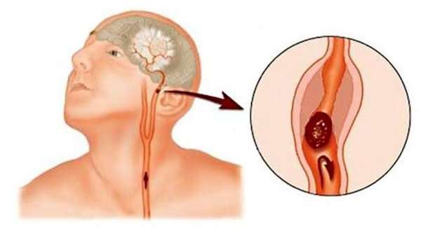 Аневризма судин головного мозку: симптоми і лікування