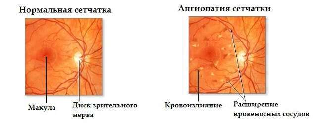 Ангіопатія сітківки ока: симптоми і лікування