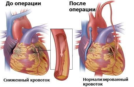 Ішемічна хвороба серця: симптоми і лікування