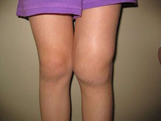 Артрит колінного суглоба: симптоми і лікування