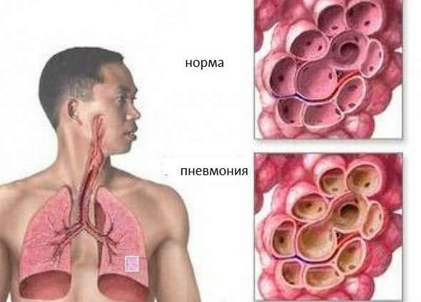 Бактеріальна пневмонія: симптоми і лікування