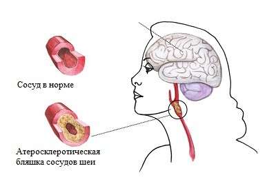 Дисциркуляторна енцефалопатія: симптоми і лікування