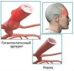 Хвороба Хортона (скроневий артеріїт): симптоми і лікування