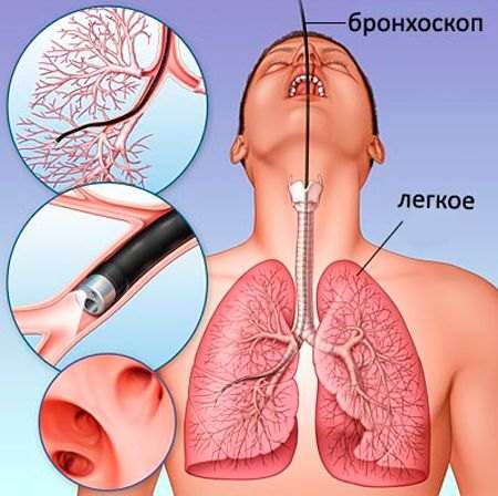 Фіброз легень: симптоми і лікування