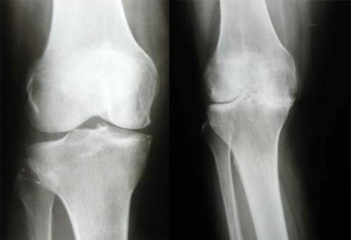 Артрит колінного суглоба: симптоми і лікування