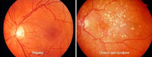 Дистрофія сітківки ока: симптоми і лікування