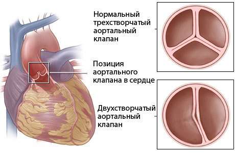 Вроджений порок серця: симптоми і лікування