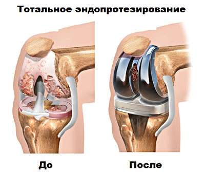 Контрактура колінного суглоба: симптоми і лікування
