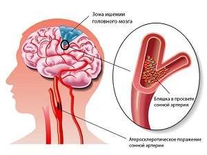 Енцефалопатія головного мозку: симптоми і лікування