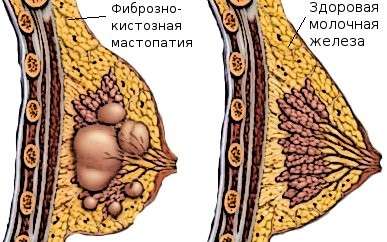 Фіброзно-кістозна мастопатія: симптоми і лікування