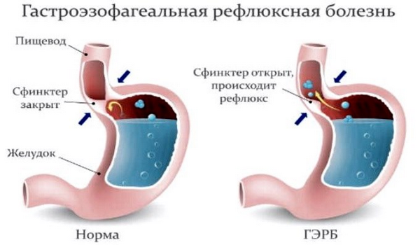 Шлунковий кашель: симптоми і лікування