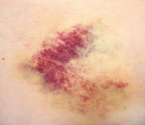 Тромбоцитопенічна Пурпура (хвороба Верльгофа): симптоми і лікування