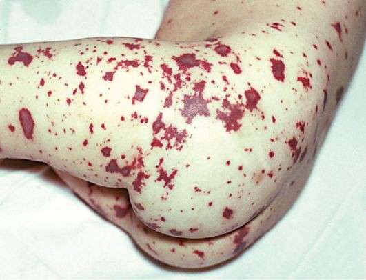 Менінгококова інфекція: симптоми і лікування