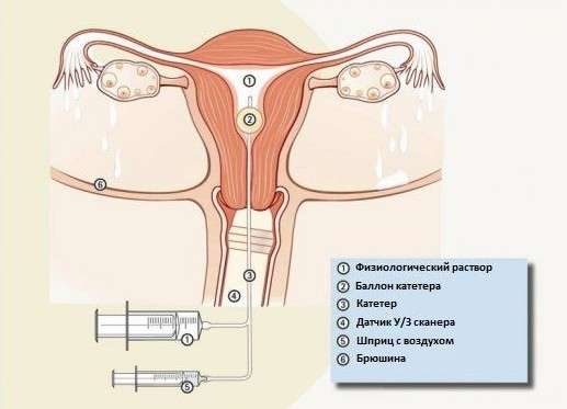 Гіпоплазія матки: симптоми і лікування