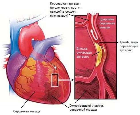 Інфаркт міокарда: симптоми і лікування