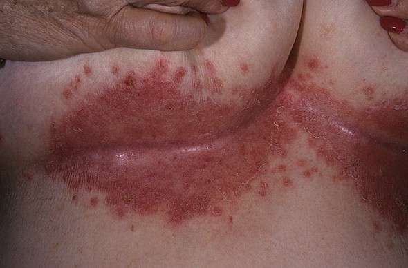 Кандидоз шкіри: симптоми і лікування