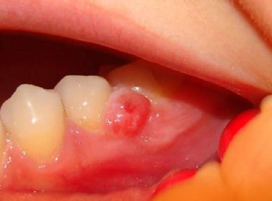 Кіста зуба: симптоми і лікування