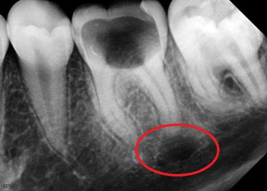 Кіста зуба: симптоми і лікування