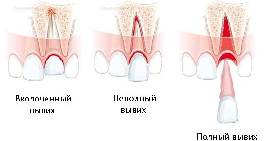 Вивих зуба: симптоми і лікування