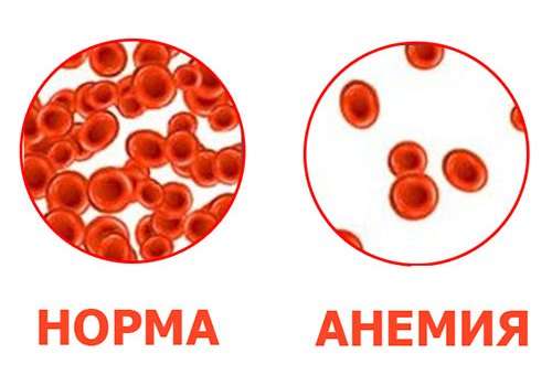 Анемія у дітей: симптоми і лікування