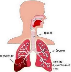 Крупозна пневмонія: симптоми і лікування