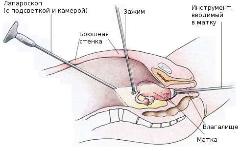 Ендометріоїдна кіста яєчника: симптоми і лікування