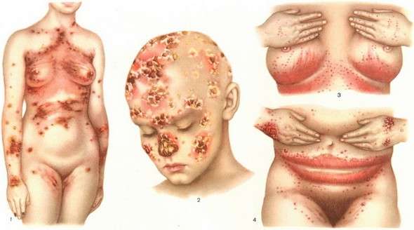 Кандидоз шкіри: симптоми і лікування