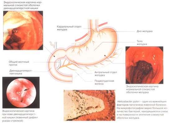 Виразка шлунка: симптоми і лікування