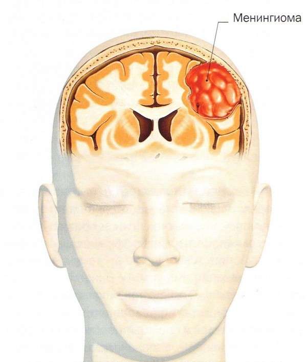 Пухлина головного мозку: симптоми і лікування