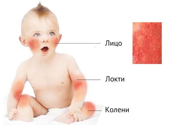Атопічний дерматит у дітей: симптоми і лікування
