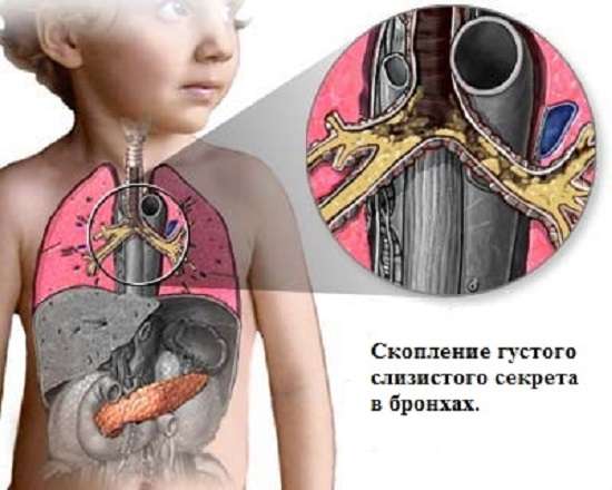 Муковісцидоз: симптоми і лікування