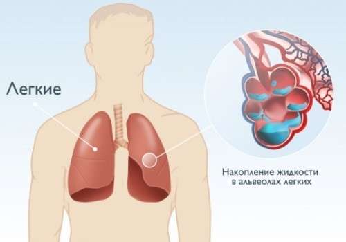 Набряк легенів: симптоми і лікування