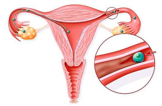 Непрохідність маткових труб: симптоми і лікування