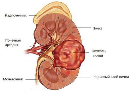 Пухлина нирки: симптоми і лікування