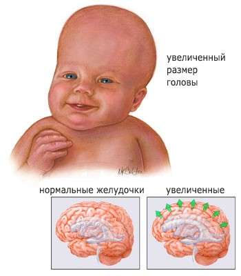 Гідроцефалія у дітей: симптоми і лікування