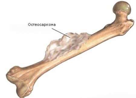 Остеосаркома: симптоми і лікування