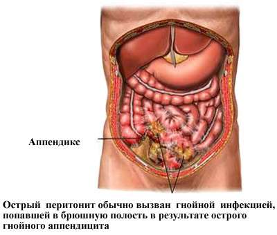Перитоніт: симптоми і лікування