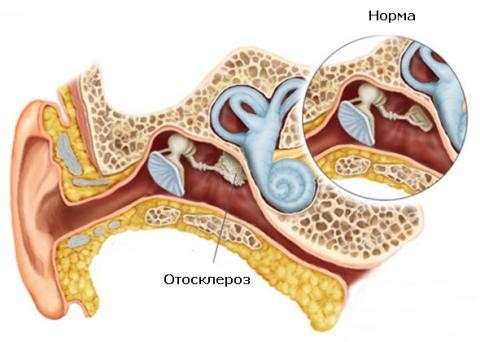 Отосклероз (отоспонгиоз): симптоми і лікування