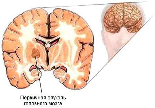 Пухлина головного мозку: симптоми і лікування