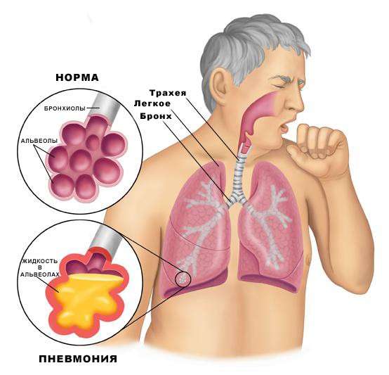 Запалення легенів: симптоми і лікування