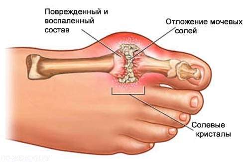 Подагричний артрит: симптоми і лікування