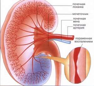 Вузликовий періартеріїт (хвороба Куссмауля-Майера): симптоми і лікування