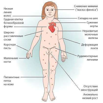Синдром Шерешевського-Тернера: симптоми і лікування