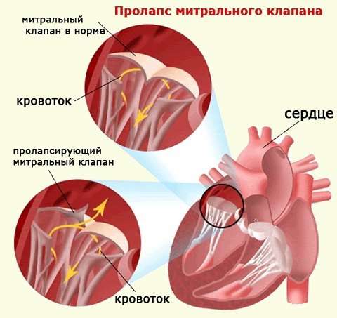 Порок серця: симптоми і лікування