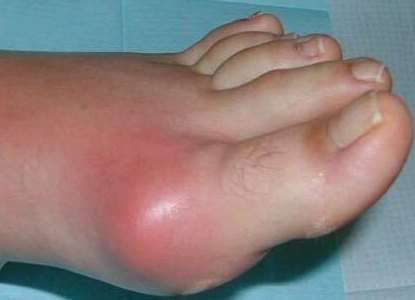 Алергічний артрит: симптоми і лікування